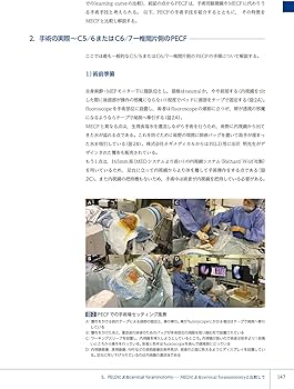 若手脊椎外科医のための内視鏡手術ガイド 岩井グループの技術の今